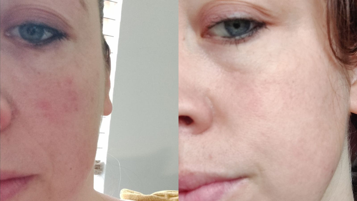 Twee close-ups van dezelfde huid naast elkaar resultaten Apple Peeling